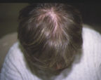 alopecie